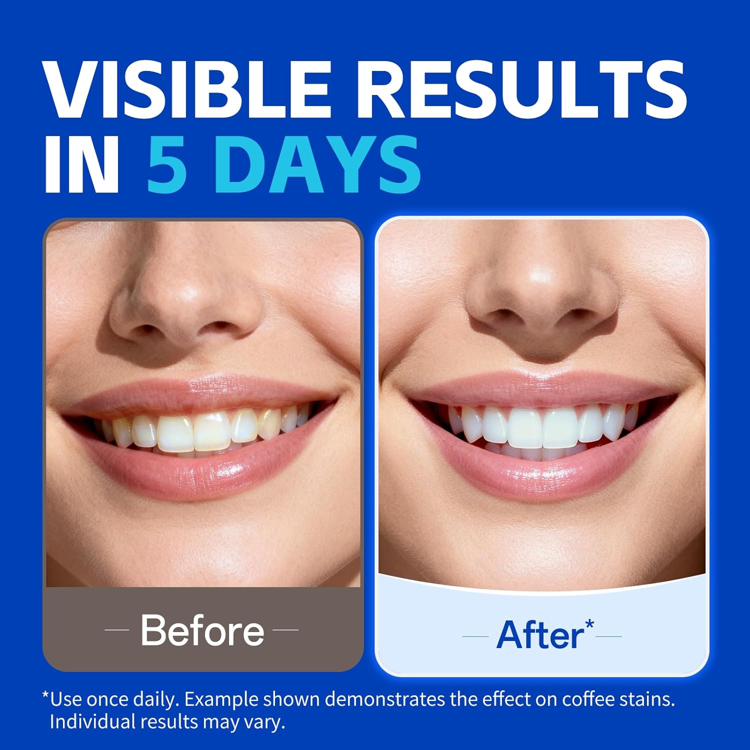 7 paires de bandes blanchissan - Teeth Whitening Retainer avis et prix