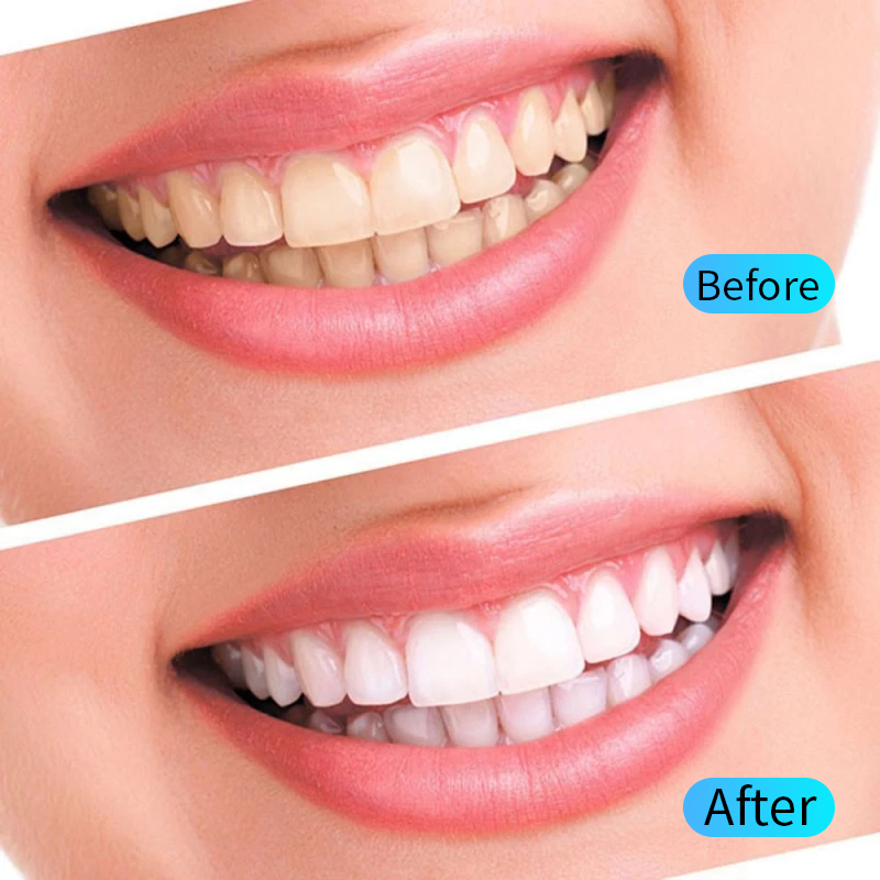 Kit de Gel de blanchiment des  - Teeth Whitening Filter avis et prix