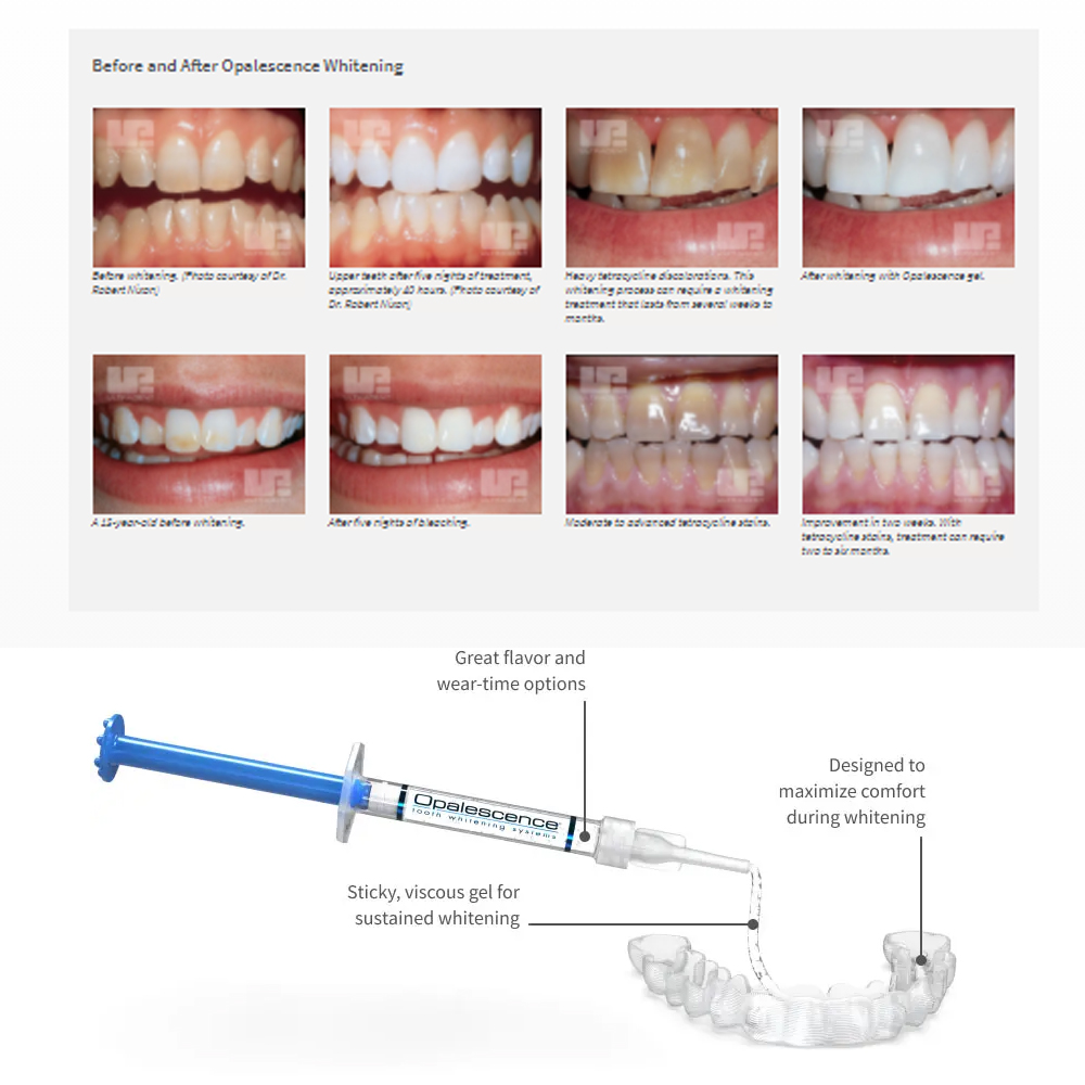 Opalwisdom-Kit de Blanchiment  - Teeth Whitening Hydrogen Peroxide avis et prix