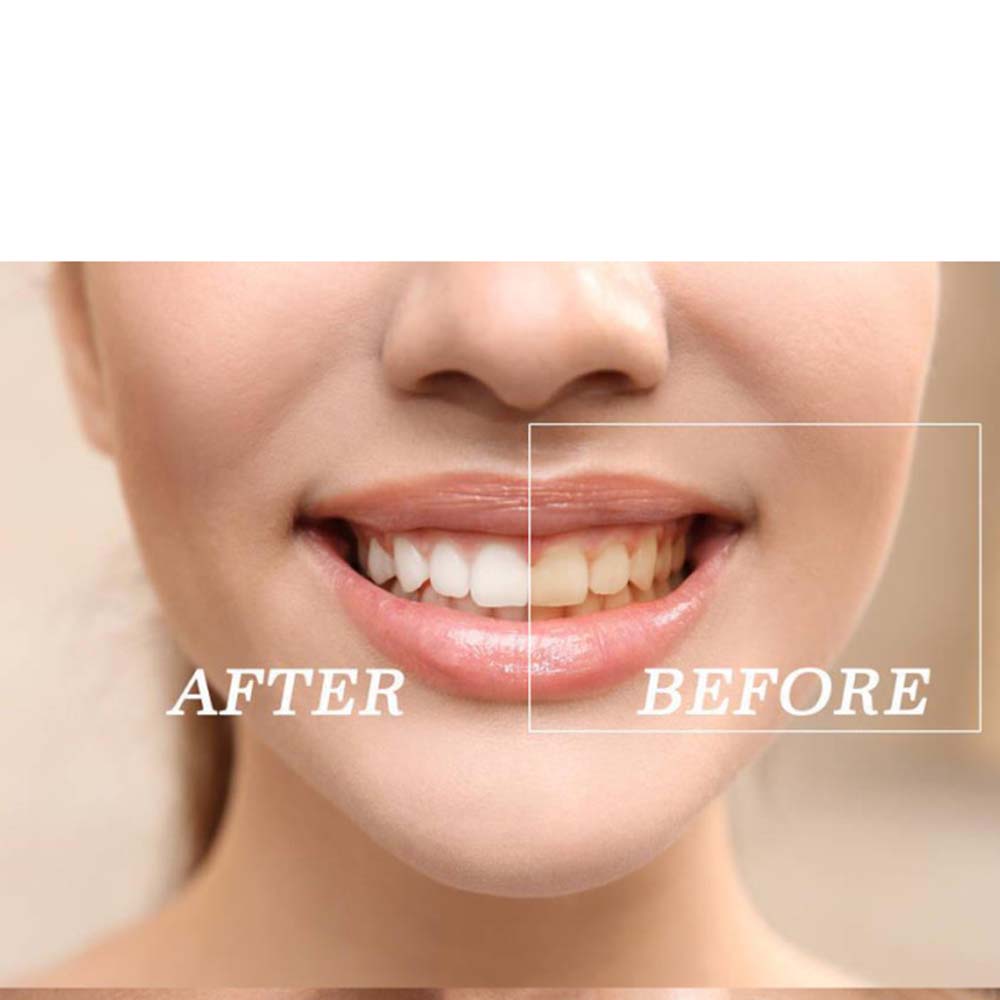 Kit de Gel de blanchiment des  - Teeth Whitening Gels avis et prix